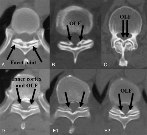 ossification of ligamentum flavum